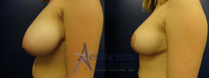 Breast Reduction Case 115 Before & After View #2 | Columbus, OH | Aesthetica Surgery & Spa
