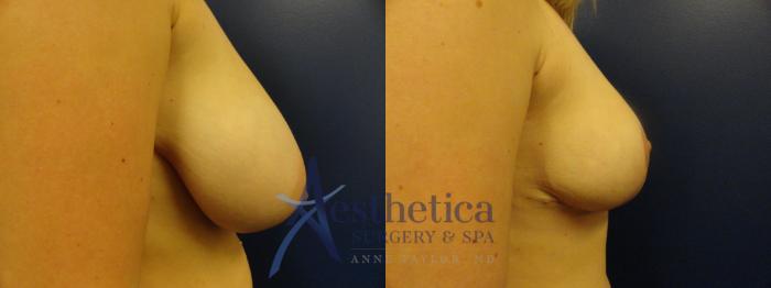 Breast Reduction Case 115 Before & After View #3 | Columbus, OH | Aesthetica Surgery & Spa