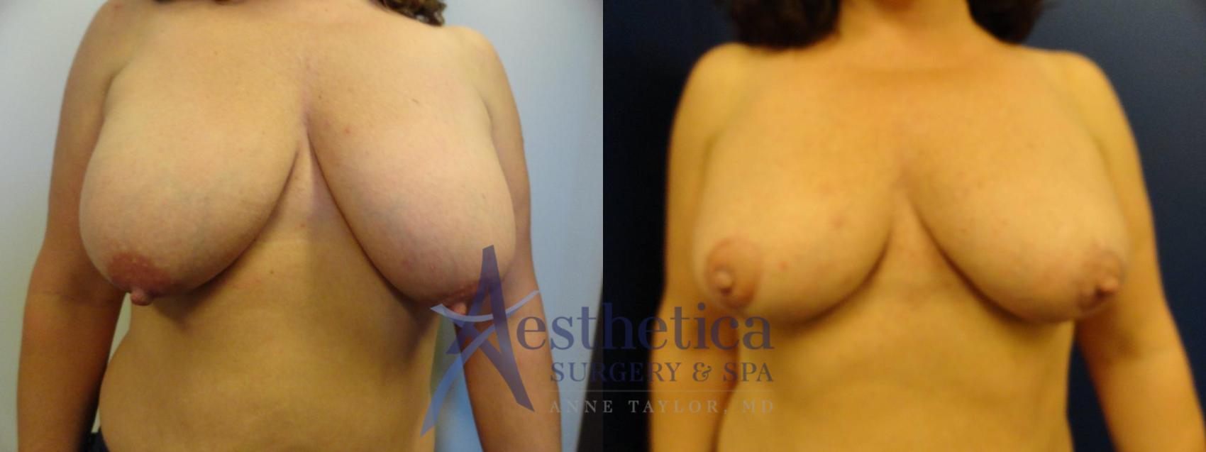 Breast Reduction Case 128 Before & After View #1 | Columbus, OH | Aesthetica Surgery & Spa