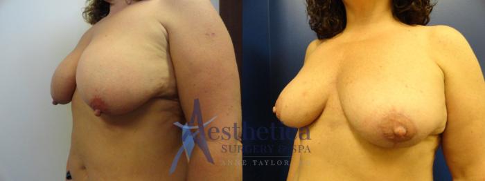 Breast Reduction Case 128 Before & After View #2 | Columbus, OH | Aesthetica Surgery & Spa