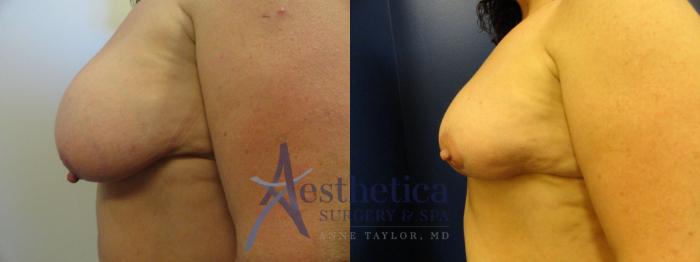 Breast Reduction Case 128 Before & After View #3 | Columbus, OH | Aesthetica Surgery & Spa