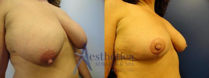Breast Reduction Case 128 Before & After View #4 | Columbus, OH | Aesthetica Surgery & Spa