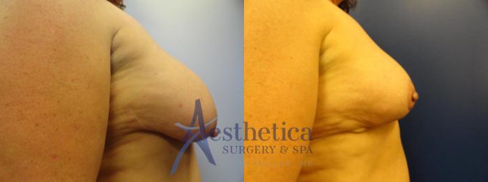 Breast Reduction Case 128 Before & After View #5 | Columbus, OH | Aesthetica Surgery & Spa