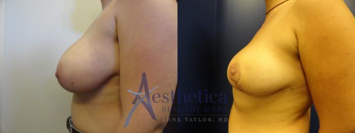 Breast Reduction Case 142 Before & After View #2 | Columbus, OH | Aesthetica Surgery & Spa