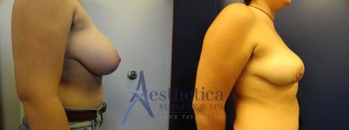 Breast Reduction Case 142 Before & After View #4 | Columbus, OH | Aesthetica Surgery & Spa