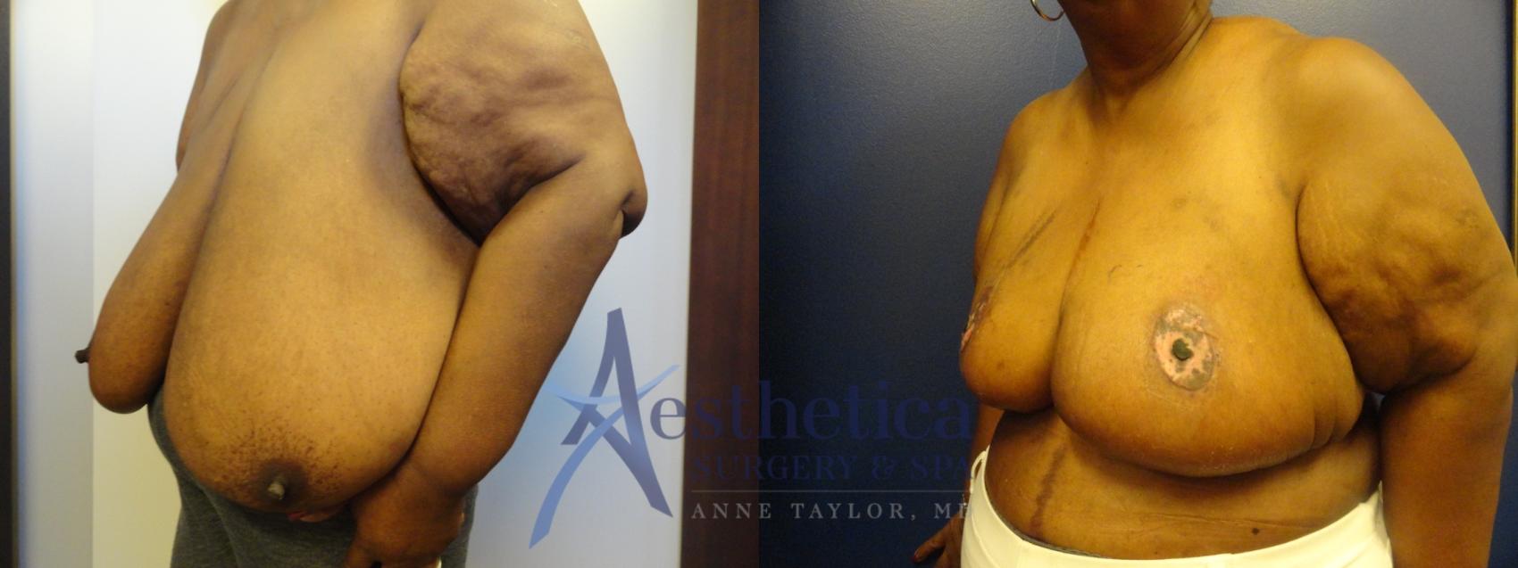 Breast Reduction Case 266 Before & After View #2 | Columbus, OH | Aesthetica Surgery & Spa