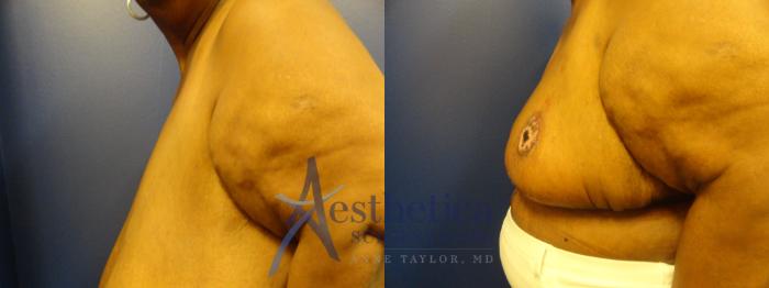 Breast Reduction Case 266 Before & After View #3 | Columbus, OH | Aesthetica Surgery & Spa