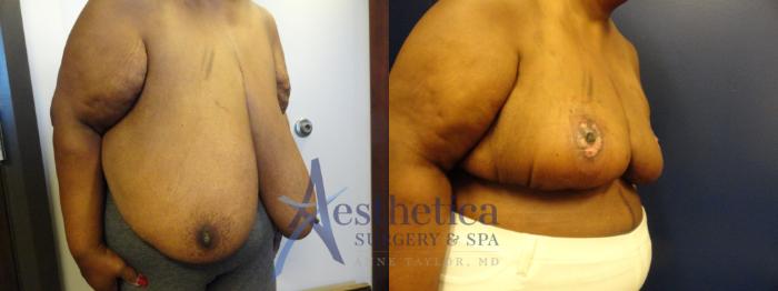 Breast Reduction Case 266 Before & After View #4 | Columbus, OH | Aesthetica Surgery & Spa