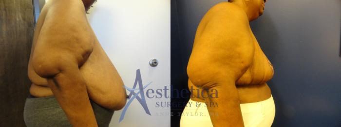 Breast Reduction Case 266 Before & After View #5 | Columbus, OH | Aesthetica Surgery & Spa
