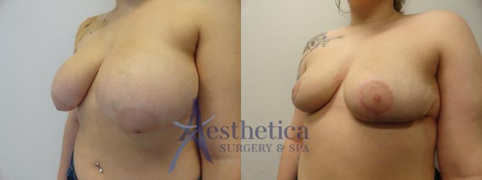 Breast Reduction Case 279 Before & After View #2 | Columbus, OH | Aesthetica Surgery & Spa