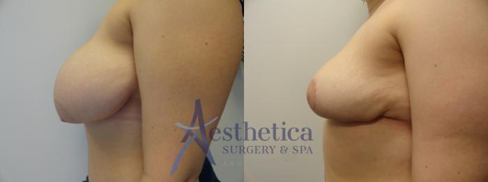 Breast Reduction Case 279 Before & After View #3 | Columbus, OH | Aesthetica Surgery & Spa