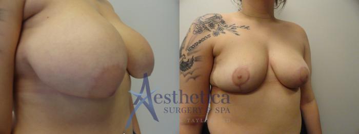 Breast Reduction Case 279 Before & After View #4 | Columbus, OH | Aesthetica Surgery & Spa
