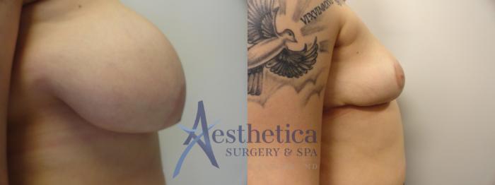 Breast Reduction Case 279 Before & After View #5 | Columbus, OH | Aesthetica Surgery & Spa