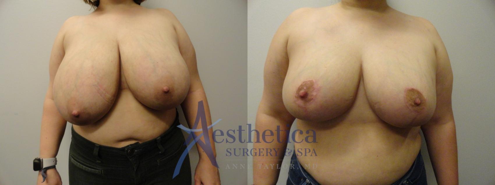 Breast Reduction Case 285 Before & After View #1 | Worthington, OH | Aesthetica Surgery & Spa