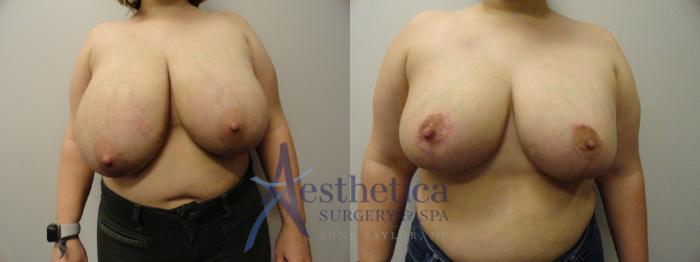 Breast Reduction Case 285 Before & After View #1 | Columbus, OH | Aesthetica Surgery & Spa