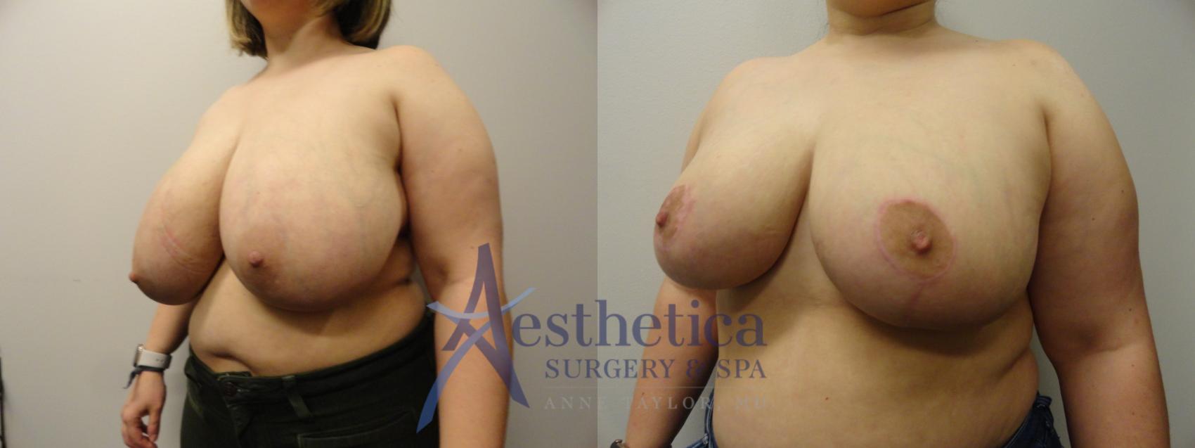 Breast Reduction Case 285 Before & After View #2 | Worthington, OH | Aesthetica Surgery & Spa
