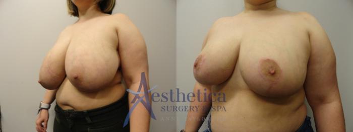 Breast Reduction Case 285 Before & After View #2 | Columbus, OH | Aesthetica Surgery & Spa