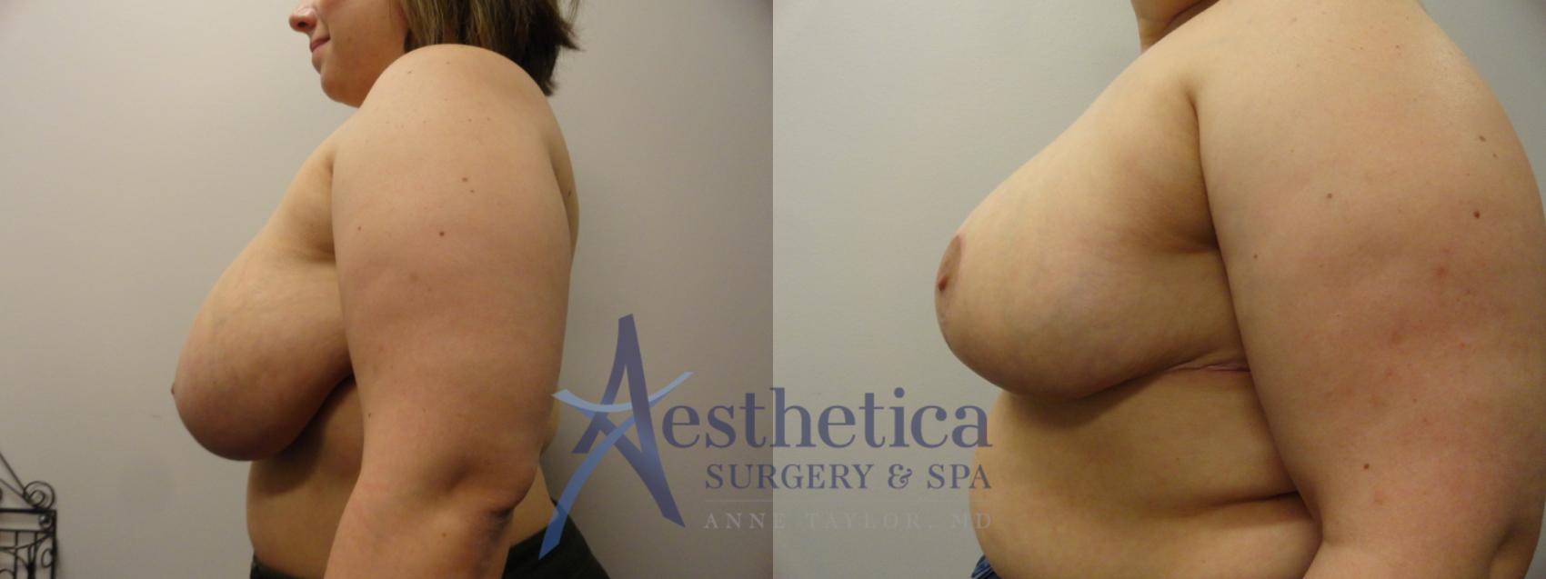 Breast Reduction Case 285 Before & After View #3 | Worthington, OH | Aesthetica Surgery & Spa