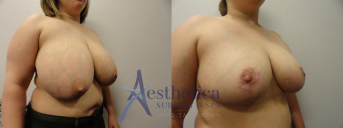 Breast Reduction Case 285 Before & After View #4 | Columbus, OH | Aesthetica Surgery & Spa