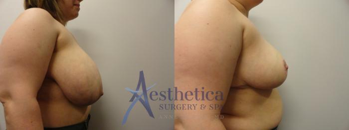 Breast Reduction Case 285 Before & After View #5 | Columbus, OH | Aesthetica Surgery & Spa