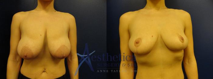 Breast Reduction Case 318 Before & After View #1 | Columbus, OH | Aesthetica Surgery & Spa