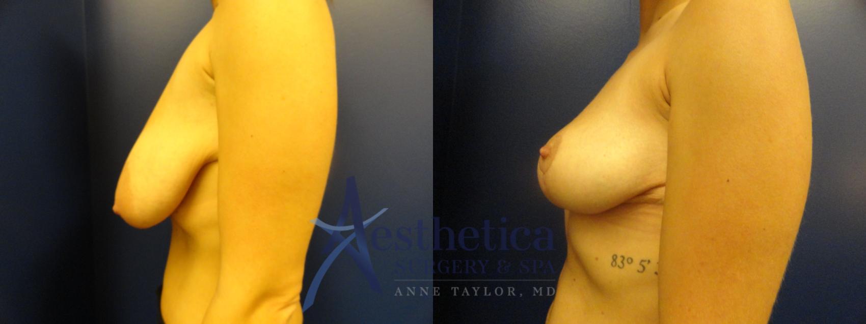 Breast Reduction Case 318 Before & After View #3 | Worthington, OH | Aesthetica Surgery & Spa