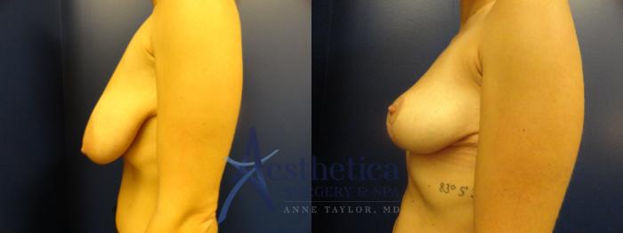 Breast Reduction Case 318 Before & After View #3 | Columbus, OH | Aesthetica Surgery & Spa