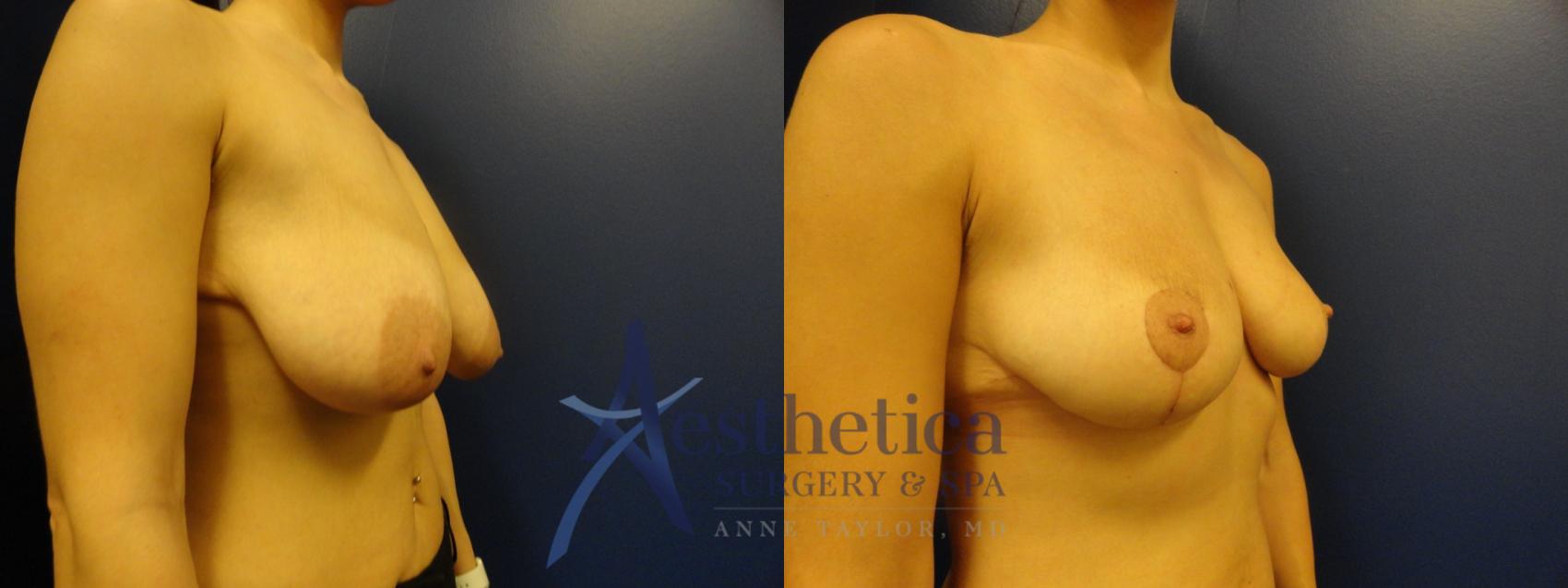 Breast Reduction Case 318 Before & After View #4 | Worthington, OH | Aesthetica Surgery & Spa