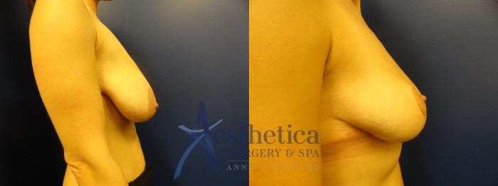Breast Reduction Case 318 Before & After View #5 | Columbus, OH | Aesthetica Surgery & Spa
