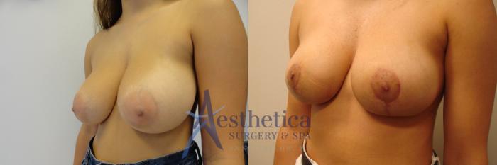 Breast Reduction Case 330 Before & After View #1 | Columbus, OH | Aesthetica Surgery & Spa
