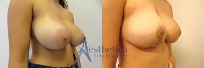 Breast Reduction Case 330 Before & After View #3 | Columbus, OH | Aesthetica Surgery & Spa