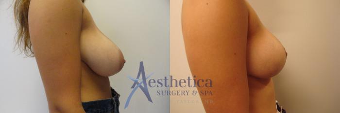 Breast Reduction Case 330 Before & After View #4 | Columbus, OH | Aesthetica Surgery & Spa