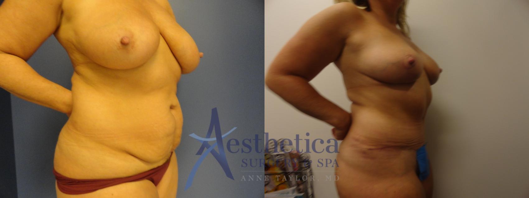 Breast Reduction Case 331 Before & After View #1 | Columbus, OH | Aesthetica Surgery & Spa