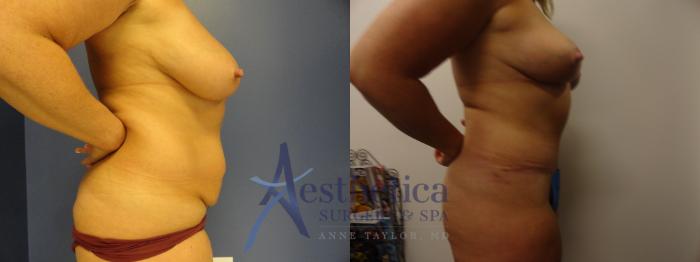 Breast Reduction Case 331 Before & After View #2 | Columbus, OH | Aesthetica Surgery & Spa