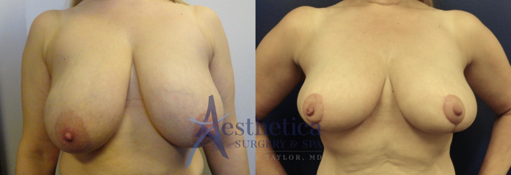 Breast Reduction Case 332 Before & After View #1 | Columbus, OH | Aesthetica Surgery & Spa