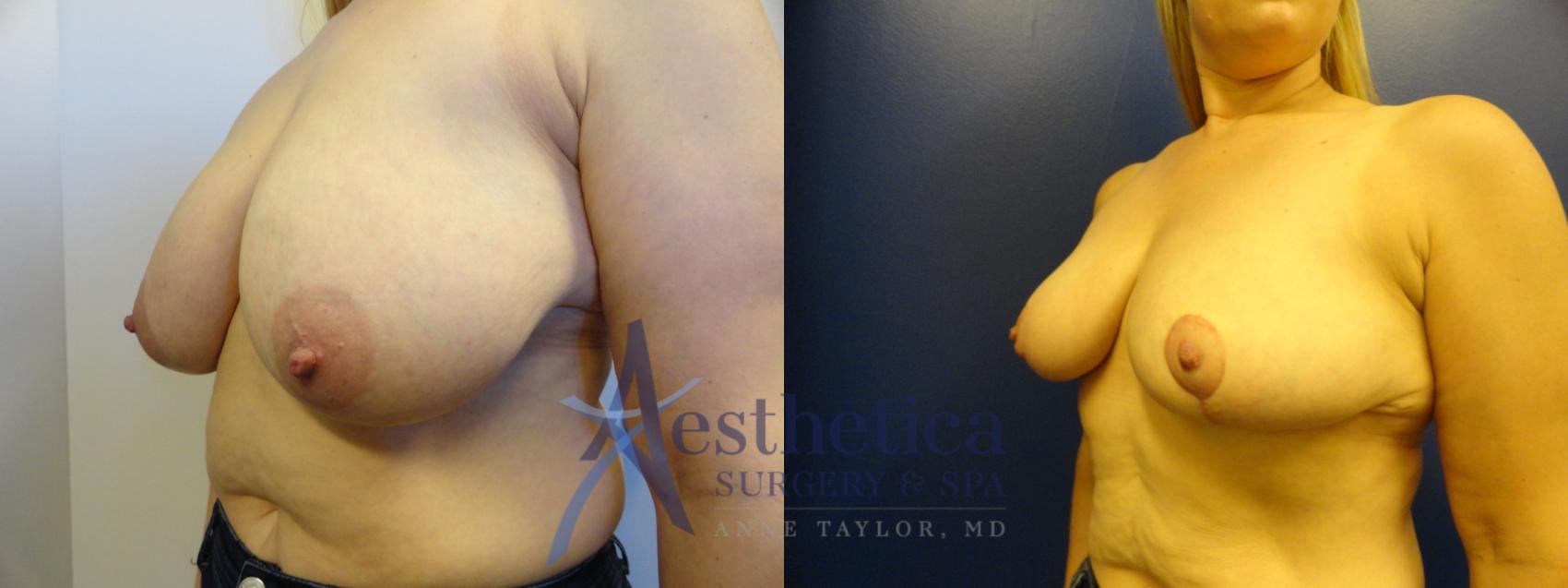 Breast Reduction Case 332 Before & After View #2 | Worthington, OH | Aesthetica Surgery & Spa