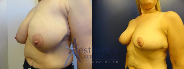 Breast Reduction Case 332 Before & After View #2 | Columbus, OH | Aesthetica Surgery & Spa