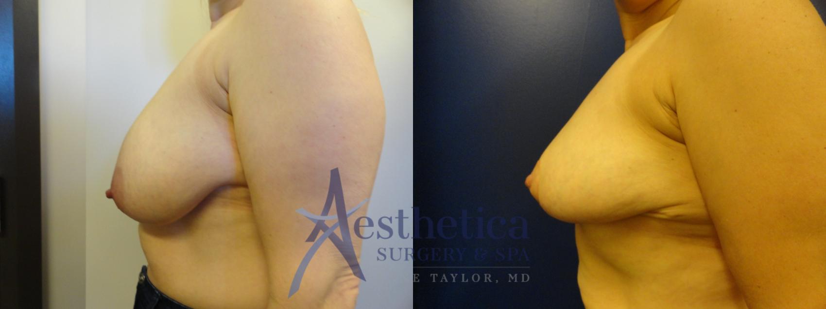 Breast Reduction Case 332 Before & After View #3 | Worthington, OH | Aesthetica Surgery & Spa