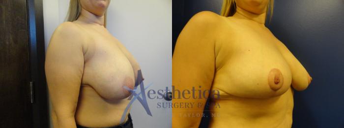 Breast Reduction Case 332 Before & After View #4 | Columbus, OH | Aesthetica Surgery & Spa