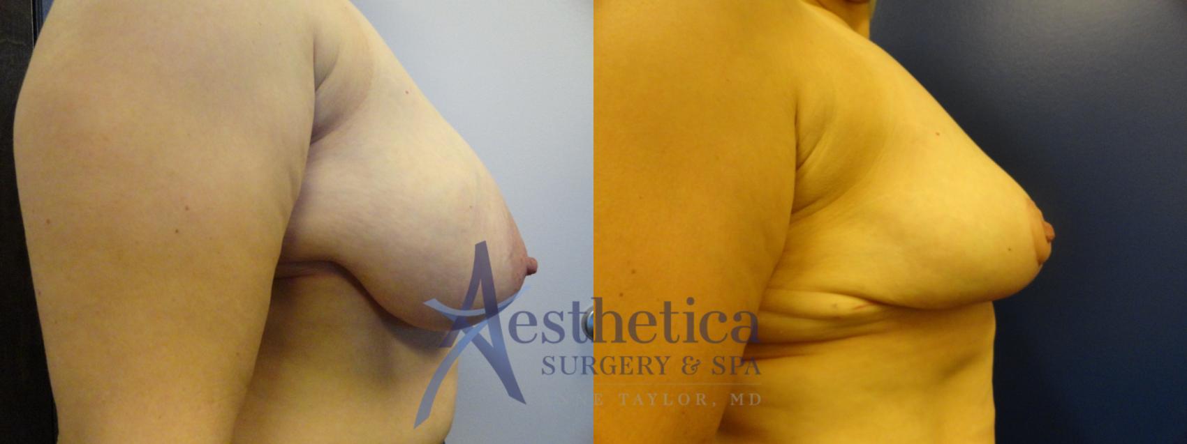 Breast Reduction Case 332 Before & After View #5 | Worthington, OH | Aesthetica Surgery & Spa