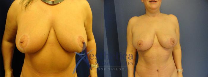 Breast Reduction Case 337 Before & After View #1 | Columbus, OH | Aesthetica Surgery & Spa