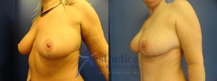 Breast Reduction Case 337 Before & After View #2 | Columbus, OH | Aesthetica Surgery & Spa