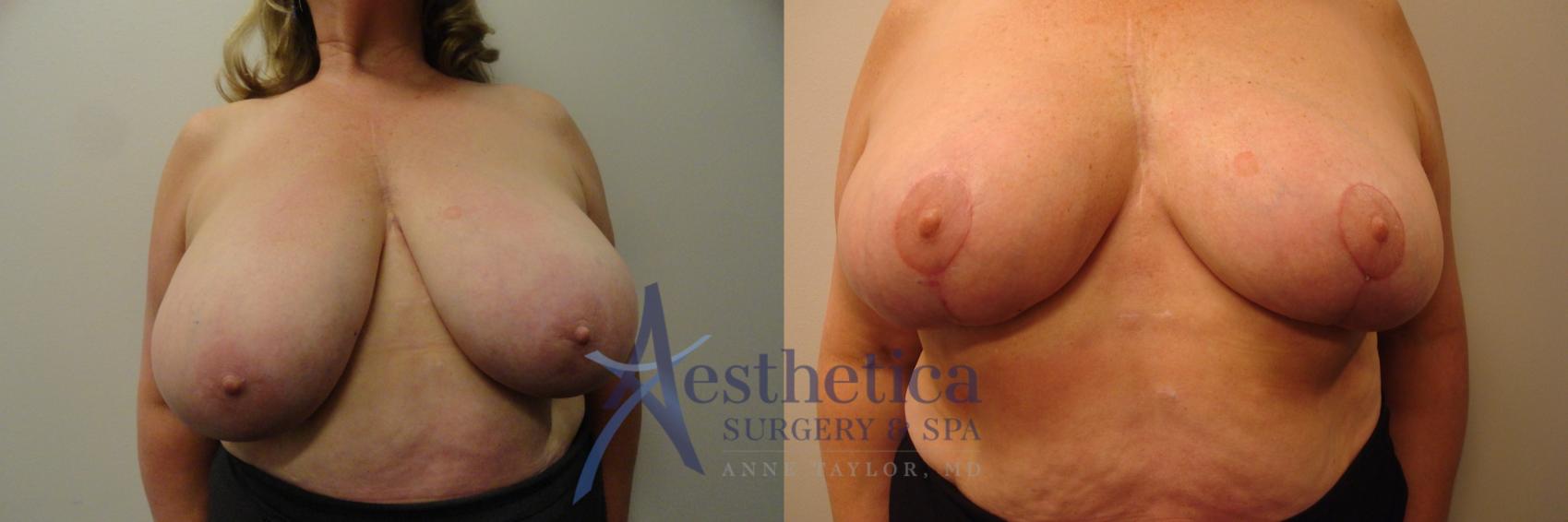 Breast Reduction Case 342 Before & After View #1 | Columbus, OH | Aesthetica Surgery & Spa