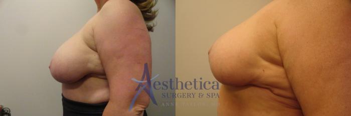Breast Reduction Case 342 Before & After View #2 | Columbus, OH | Aesthetica Surgery & Spa