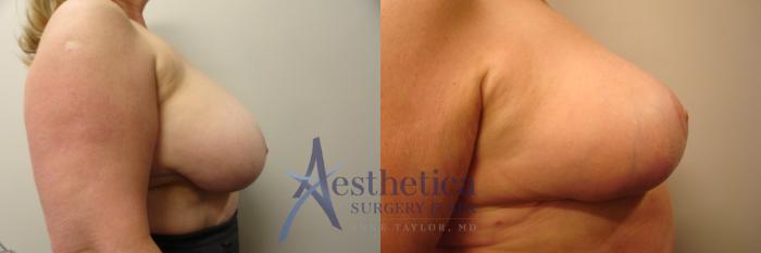 Breast Reduction Case 342 Before & After View #3 | Columbus, OH | Aesthetica Surgery & Spa