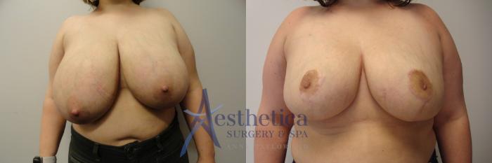 Breast Reduction Case 349 Before & After View #1 | Columbus, OH | Aesthetica Surgery & Spa
