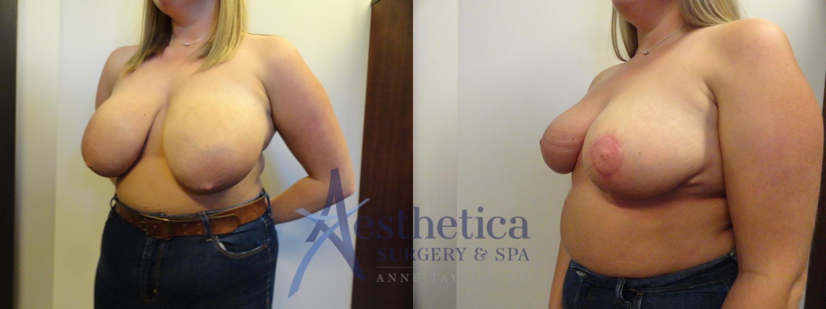 Breast Reduction Case 395 Before & After View #2 | Columbus, OH | Aesthetica Surgery & Spa