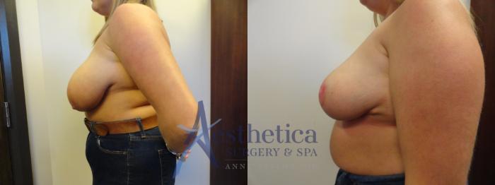 Breast Reduction Case 395 Before & After View #3 | Columbus, OH | Aesthetica Surgery & Spa