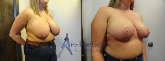 Breast Reduction Case 395 Before & After View #4 | Columbus, OH | Aesthetica Surgery & Spa