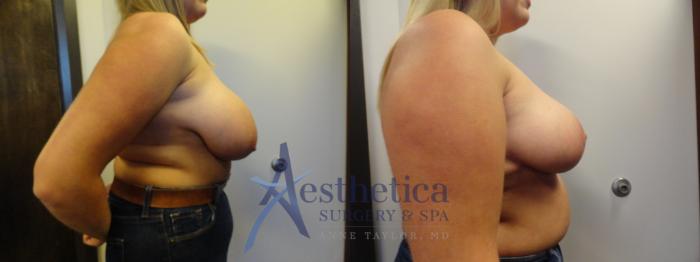 Breast Reduction Case 395 Before & After View #5 | Columbus, OH | Aesthetica Surgery & Spa